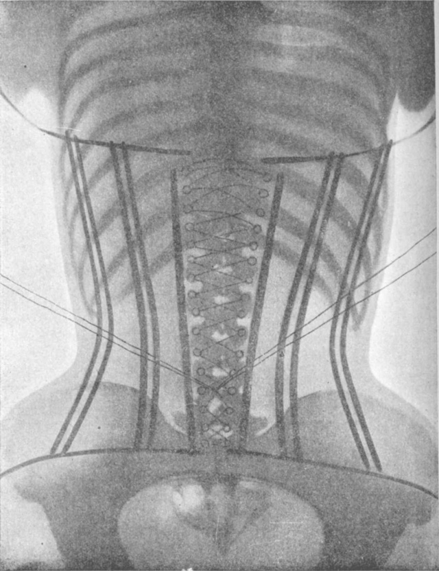 woman xray